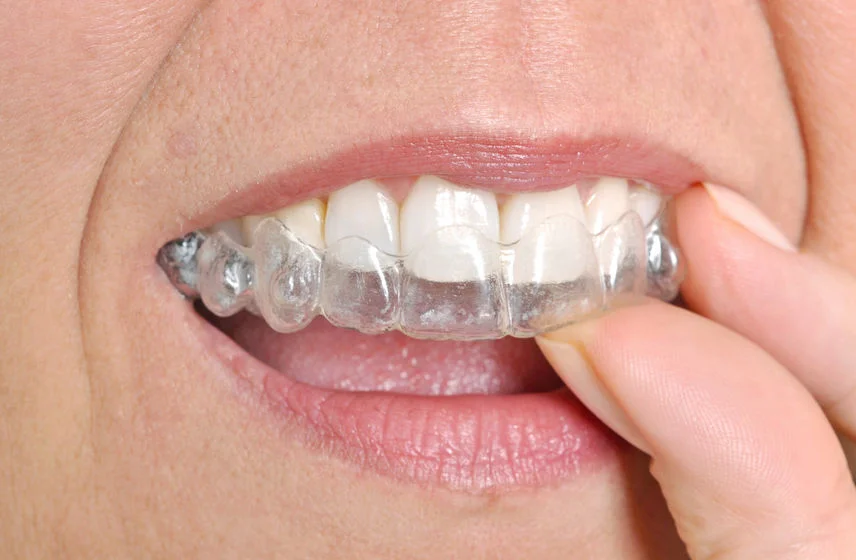 3 Advantages of Choosing Clear Aligners Over Traditional Braces