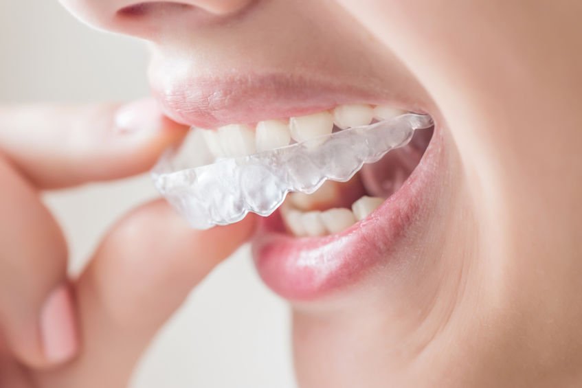 Consider Clear Aligners to Correct Your Smile