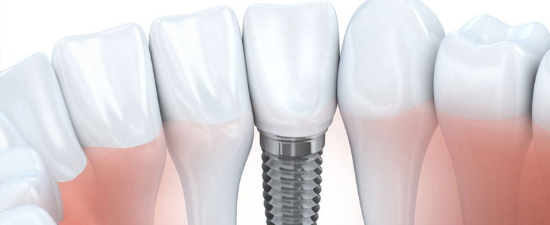 About Dental Implants
