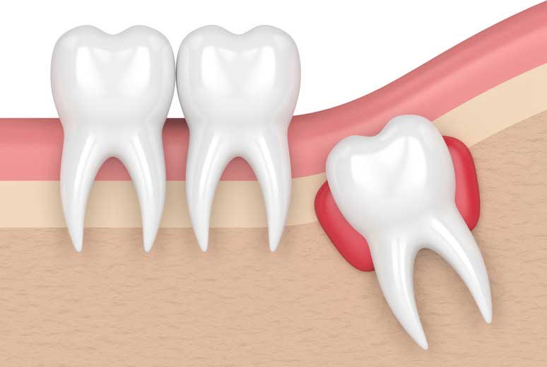 Common Signs That You Need Your Wisdom Tooth Extracted