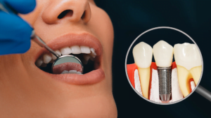 prepare for dental implants